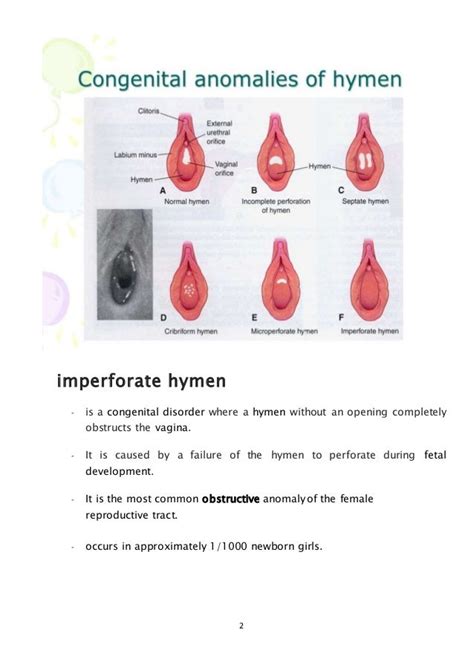 Imperforate hymen